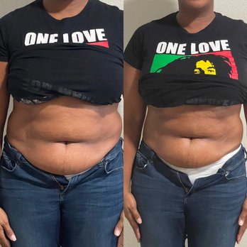 Bbetter Wellness Spa - Before and after lipo - 2 in. loss - Body Contouring Near Me - Frisco, Texas Bbetter Wellness Spa - Before and after lipo - 2 in. loss - Body Contouring Near Me - Frisco, Texas