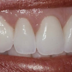 Kathleen McClintock, DDS - Procera Crowns - Very Lifelike