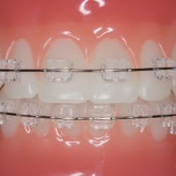 Premier Braces