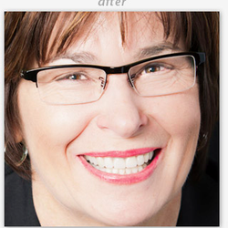 Arbor Lakes Dental - A cosmetic dental patient after treatment