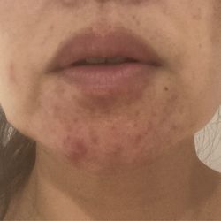 Anna Logan Skincare - Before seeing Anna