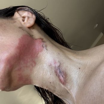 Salon Bisou - Aftermath chemical peel with Suzy Topjian Minassian @suziesbrowglowstudio - Nail Salons Near Me - La Cañada Flintridge, California Salon Bisou - Aftermath chemical peel with Suzy Topjian Minassian @suziesbrowglowstudio - Nail Salons Near Me - La Cañada Flintridge, California