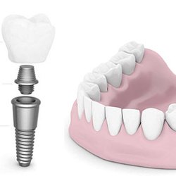 Clifton Advanced Dentistry - Dental Implants in Clifton NJ 07011