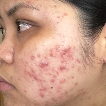 Luxe & Nova - Before seeing Aliya in 2023 - Skin Care Near Me - Waipahu, Hawaii Luxe & Nova - Before seeing Aliya in 2023 - Skin Care Near Me - Waipahu, Hawaii