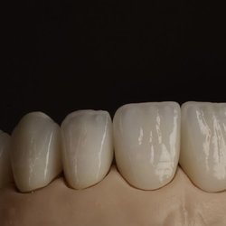 M.I. Dental Designs - Veneers