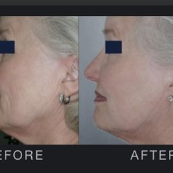 Adirondack Laser & Skin Esthetics - Photo Rejuvenation