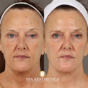 Spa Aesthetica Medical Spa & Wellness Center - 3 Months of using OBAGI Nu Derm System - Laser Hair Removal Near Me - E Orange, California Spa Aesthetica Medical Spa & Wellness Center - 3 Months of using OBAGI Nu Derm System - Laser Hair Removal Near Me - E Orange, California