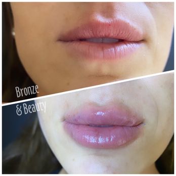 bronze_n_beauty - More lip filler - Spray Tanning Near Me