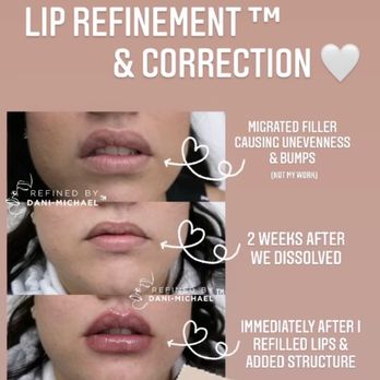 Synergy Medical Aesthetics - My lip injection journey summed up - Skin Care Near Me - Upland, California Synergy Medical Aesthetics - My lip injection journey summed up - Skin Care Near Me - Upland, California