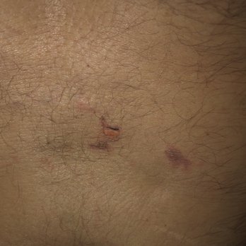 AB Acupuncture - Right after getting burned - Acupuncture Near Me - El Cajon, California