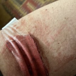 Providence - Santa Rosa - Blood accumulated into where are the needle was removed from the IV drip -- This is the way I was discharged in a wheelchair to an Uber.