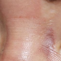 Bodysculpture NOVA - A day after procedure, the bruise appears on the side of my eye. I had it done many times somewhere else but never had any bruise like this.