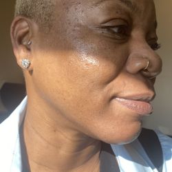 MediSpa Me-In - After mole removal