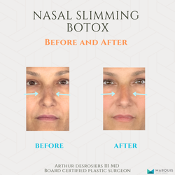 Marquis Plastic Surgery - Nasal Slimming Botox Before & After Results | Dr. Arthur Desrosiers