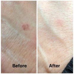Cindy Ann Ravn - Got spots? I can get rid of them.