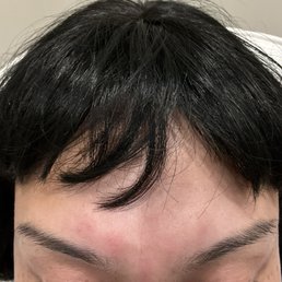 Botox Botox