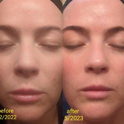 Chernoff Cosmetic Surgery - Before and after DOT with PRP