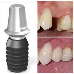 Warner Dental - Concept of implant tooth, upper left premolar implant tooth (12)