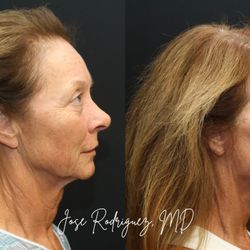 Deep Plane Facelift