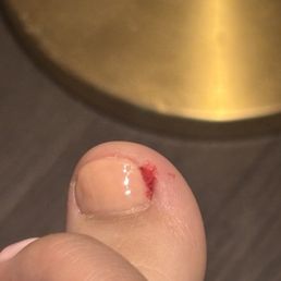 Bleeding from pedicure. Bleeding from pedicure.