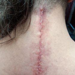 SCL Health - Incision