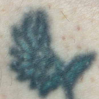 Bare with Me Electrology - Before - Hair Removal Near Me - Las Vegas, Nevada Bare with Me Electrology - Before - Hair Removal Near Me - Las Vegas, Nevada