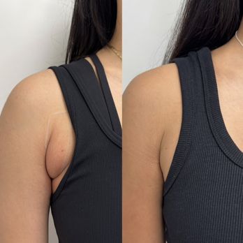 Rejuven8 OC - Targeted Sculpt - Body Contouring Near Me - Newport Beach, California Rejuven8 OC - Targeted Sculpt - Body Contouring Near Me - Newport Beach, California