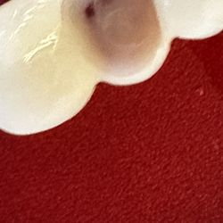 Modern Family Dentistry - One hole in the denture, one about to happen