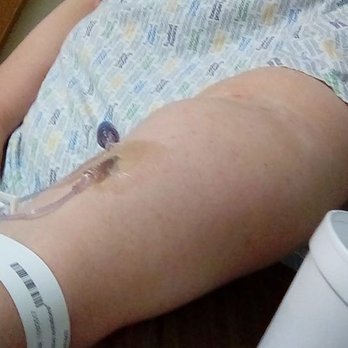 WellStar Paulding Hospital - This IV began leaking under my skin and you can see how swollen it was between IV and elbow - Medical Centers Near Me - Hiram, Georgia