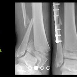 Denten Eldredge, DPM -  Napa Solano Foot and Ankle - Foot and Ankle Trauma