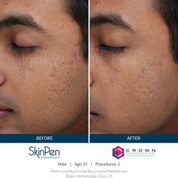 Oak Park Laser and Skin Clinic - Microneedling for Acne Marks before and after