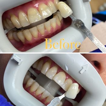 Alesia Belaya - Cedars Dentistry - Philips Zoom whitening before and after - Cosmetic Dentists Near Me - Ventura, California Alesia Belaya - Cedars Dentistry - Philips Zoom whitening before and after - Cosmetic Dentists Near Me - Ventura, California