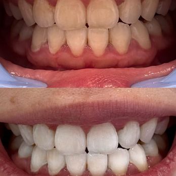 Omni Plastic Surgery - Teeth whitening - Medical Spas Near Me - Bellevue, Washington Omni Plastic Surgery - Teeth whitening - Medical Spas Near Me - Bellevue, Washington