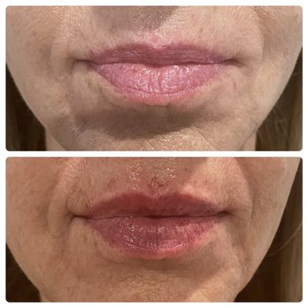 Vanity Aesthetics Lounge - Lip Filler by Kim Knight APRN - Skin Care Near Me - Fort Myers, Florida Vanity Aesthetics Lounge - Lip Filler by Kim Knight APRN - Skin Care Near Me - Fort Myers, Florida