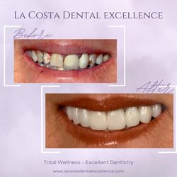 La Costa Dental Excellence - Invisalign clear braces at La Costa Dental Excellence, Carlsbad, CA