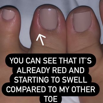 Vida Nail Spa - Infected toe not even a whole 24 hours after getting services done - Nail Salons Near Me - Oakley, California Vida Nail Spa - Infected toe not even a whole 24 hours after getting services done - Nail Salons Near Me - Oakley, California