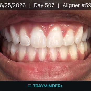 Humphries Orthodontics - Had the best experience with my Invisalign treatment. They were really kind and helpful. Smooth appointments. Very happy with my results - Orthodontists Near Me - Artesia, California