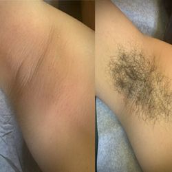 Cassas Aesthetics - Underarm Wax