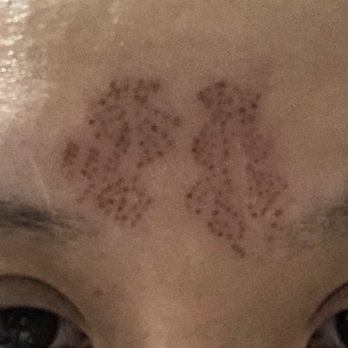 My Perfect Skin Clinic - Right after procedure done. Dots placement is so off - Skin Care Near Me - Gilbert, Arizona