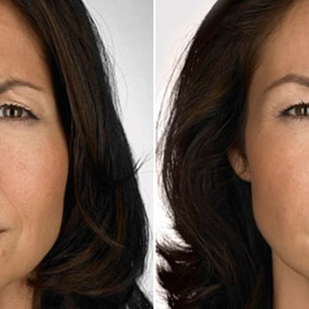 Dyson Dermatology - Before and After Botox - Dermatologists Near Me - Green Valley, Arizona