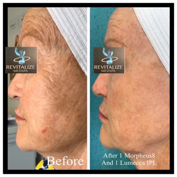 Revitalize Medspa - Before and After 1 Morpheus8 and Lumecca treatments - Medical Spas Near Me - New Braunfels, Texas Revitalize Medspa - Before and After 1 Morpheus8 and Lumecca treatments - Medical Spas Near Me - New Braunfels, Texas