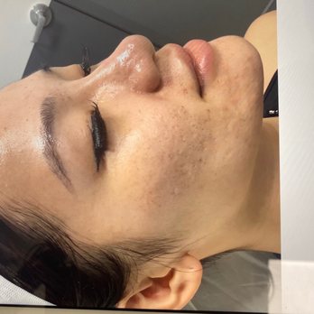 Renew ND Medspa - Before my acne scaring and oily composition. - Medical Spas Near Me - Everett, Washington