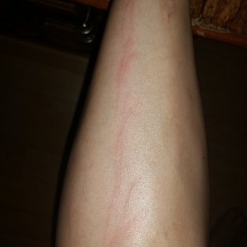 Nature's Moon Thai Spa - Nail marks on my shin - Massage Near Me - Burbank, California
