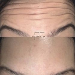 Botox by Nurse Fay.