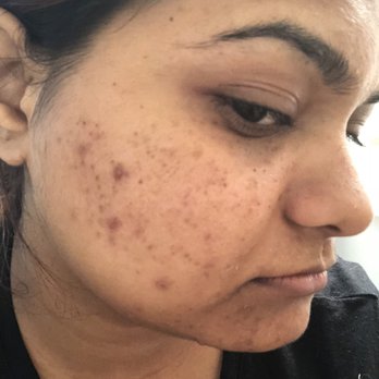 Bloom Skincare Facials & Waxing - My before pic. I think this was after the second sitting though. ( I wish I had documented this better). - Skin Care Near Me - Los Altos, California