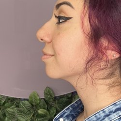 SKIN By Miss M - Non-surgical Nose Correction w Hyaluronic Pen