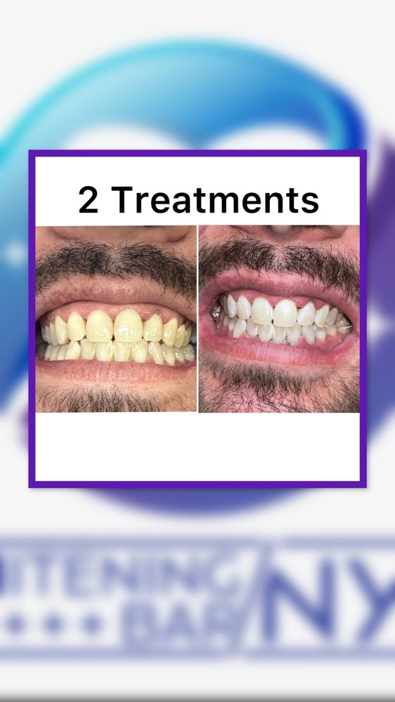 NYC Teeth Whitening 2024 Price Guide & Options