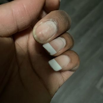 Venetian Nail Spa - Front view of finger nail that popped off. Index finger showing the black stuff on it - Nail Salons Near Me - Plantation, Florida Venetian Nail Spa - Front view of finger nail that popped off. Index finger showing the black stuff on it - Nail Salons Near Me - Plantation, Florida