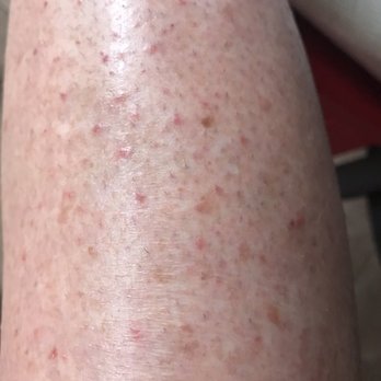 Ameristar Black Hawk - That would be my leg covered in bedbugs bites - Casinos Near Me - Black Hawk, Colorado
