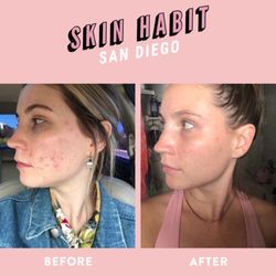Skin Habit - Before & After